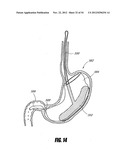 METHODS AND DEVICES FOR INTRAGASTRIC SUPPORT OF FUNCTIONAL OR PROSTHETIC     GASTROINTESTINAL DEVICES diagram and image