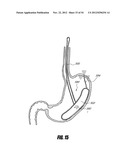 METHODS AND DEVICES FOR INTRAGASTRIC SUPPORT OF FUNCTIONAL OR PROSTHETIC     GASTROINTESTINAL DEVICES diagram and image