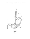 METHODS AND DEVICES FOR INTRAGASTRIC SUPPORT OF FUNCTIONAL OR PROSTHETIC     GASTROINTESTINAL DEVICES diagram and image