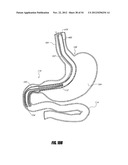 METHODS AND DEVICES FOR INTRAGASTRIC SUPPORT OF FUNCTIONAL OR PROSTHETIC     GASTROINTESTINAL DEVICES diagram and image