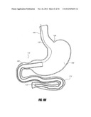 METHODS AND DEVICES FOR INTRAGASTRIC SUPPORT OF FUNCTIONAL OR PROSTHETIC     GASTROINTESTINAL DEVICES diagram and image