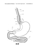 METHODS AND DEVICES FOR INTRAGASTRIC SUPPORT OF FUNCTIONAL OR PROSTHETIC     GASTROINTESTINAL DEVICES diagram and image