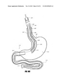 METHODS AND DEVICES FOR INTRAGASTRIC SUPPORT OF FUNCTIONAL OR PROSTHETIC     GASTROINTESTINAL DEVICES diagram and image