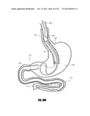 METHODS AND DEVICES FOR INTRAGASTRIC SUPPORT OF FUNCTIONAL OR PROSTHETIC     GASTROINTESTINAL DEVICES diagram and image