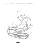 METHODS AND DEVICES FOR INTRAGASTRIC SUPPORT OF FUNCTIONAL OR PROSTHETIC     GASTROINTESTINAL DEVICES diagram and image