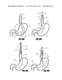 METHODS AND DEVICES FOR INTRAGASTRIC SUPPORT OF FUNCTIONAL OR PROSTHETIC     GASTROINTESTINAL DEVICES diagram and image