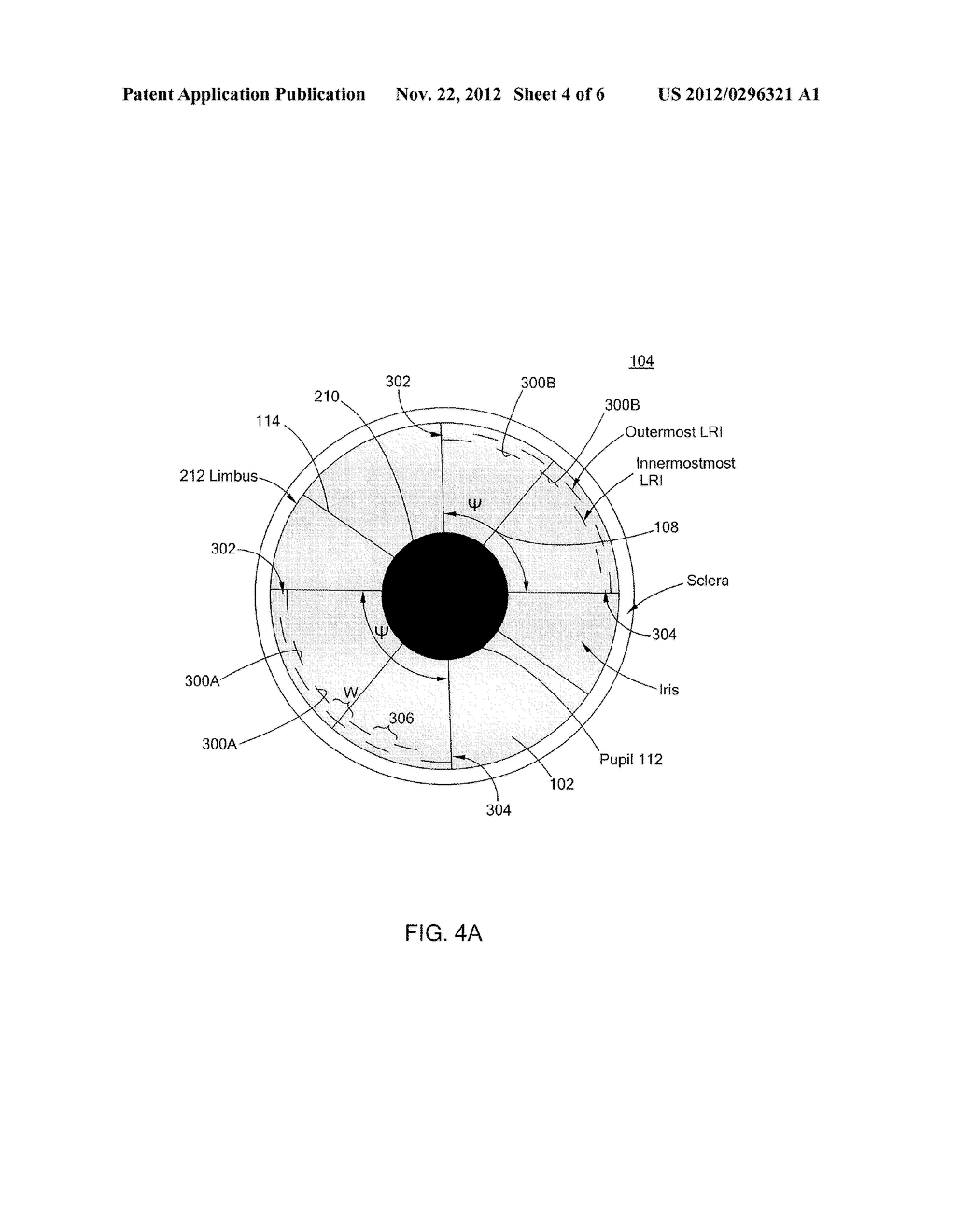 SYSTEM AND METHOD FOR CORRECTING ASTIGMATISM USING MULTIPLE PAIRED ARCUATE     LASER GENERATED CORNEAL INCISIONS - diagram, schematic, and image 05