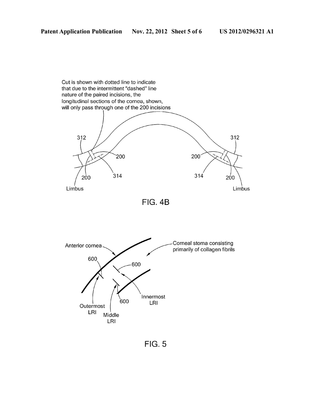 SYSTEM AND METHOD FOR CORRECTING ASTIGMATISM USING MULTIPLE PAIRED ARCUATE     LASER GENERATED CORNEAL INCISIONS - diagram, schematic, and image 06