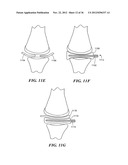 JOINT ARTHROPLASTY DEVICES AND SURGICAL TOOLS diagram and image