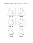 JOINT ARTHROPLASTY DEVICES AND SURGICAL TOOLS diagram and image