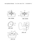 JOINT ARTHROPLASTY DEVICES AND SURGICAL TOOLS diagram and image