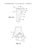 JOINT ARTHROPLASTY DEVICES AND SURGICAL TOOLS diagram and image