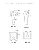 JOINT ARTHROPLASTY DEVICES AND SURGICAL TOOLS diagram and image