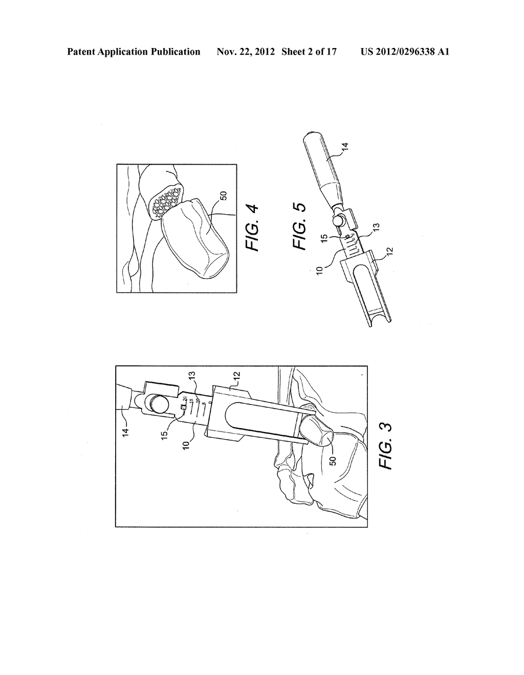 LATARJET INSTRUMENTATION AND METHOD - diagram, schematic, and image 03