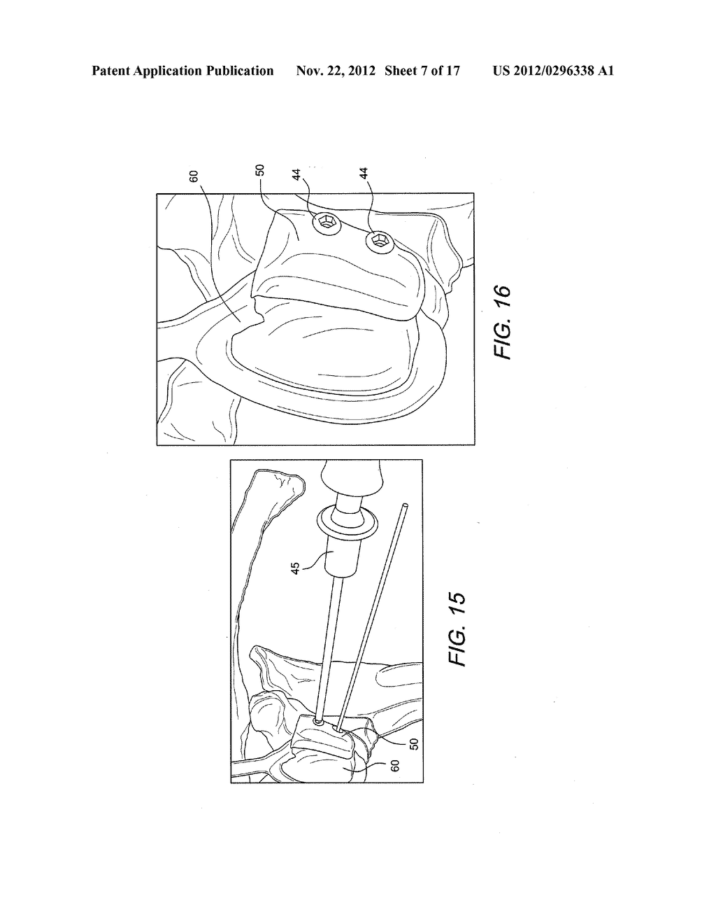 LATARJET INSTRUMENTATION AND METHOD - diagram, schematic, and image 08