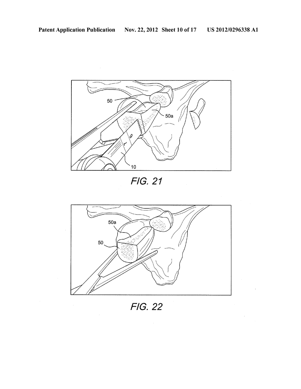 LATARJET INSTRUMENTATION AND METHOD - diagram, schematic, and image 11