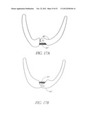 System and method for hyoidplasty diagram and image