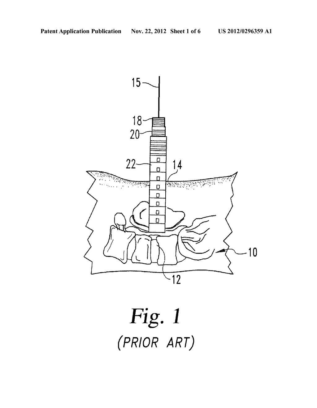 DILATION INSTRUMENTS AND METHODS - diagram, schematic, and image 02