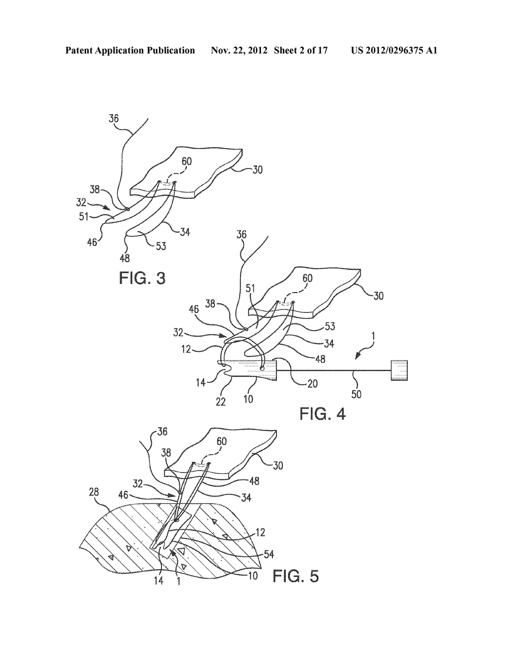 MULTI-LOOP ADJUSTABLE KNOTLESS ANCHOR ASSEMBLY, ADJUSTABLE CAPTURE     MECHANISM, AND METHOD FOR REPAIR - diagram, schematic, and image 03