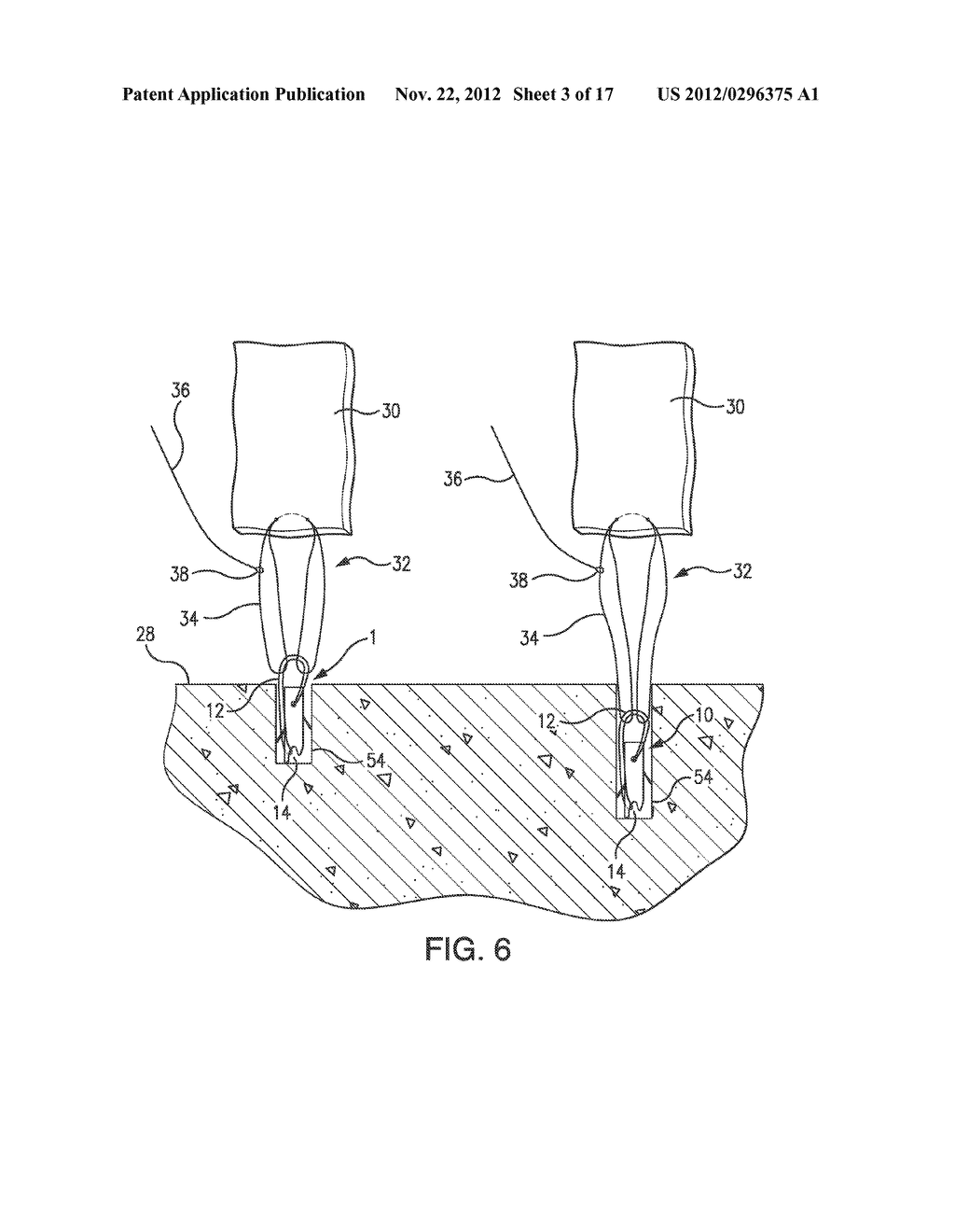 MULTI-LOOP ADJUSTABLE KNOTLESS ANCHOR ASSEMBLY, ADJUSTABLE CAPTURE     MECHANISM, AND METHOD FOR REPAIR - diagram, schematic, and image 04