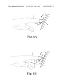 DIGITAL SUTURE FIXATION SYSTEM diagram and image