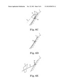 DIGITAL SUTURE FIXATION SYSTEM diagram and image