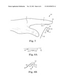 DIGITAL SUTURE FIXATION SYSTEM diagram and image