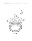 EXPANDABLE INTERSPINOUS PROCESS SPACER WITH LATERAL SUPPORT AND METHOD FOR     IMPLANTATION diagram and image