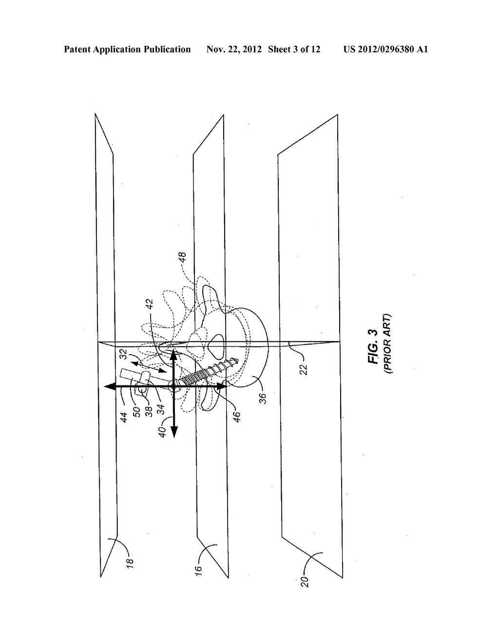 HINGED BONE SCREW WITH A TULIP BULB CONNECTOR IN A SPINAL FIXATION     ASSEMBLY - diagram, schematic, and image 04