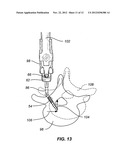 HINGED BONE SCREW WITH A TULIP BULB CONNECTOR IN A SPINAL FIXATION     ASSEMBLY diagram and image