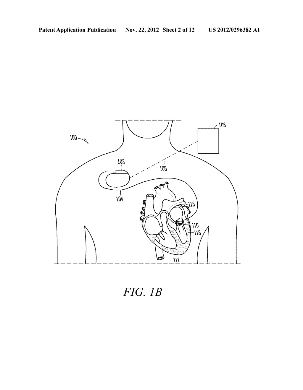 INTEGRATED CARDIAC RHYTHM MANAGEMENT SYSTEM WITH HEART VALVE - diagram, schematic, and image 03