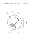 SURGICAL IMPLANT FOR ELECTRONIC ACTIVATION OF DYSFUNCTIONAL EUSTACHIAN     TUBE diagram and image