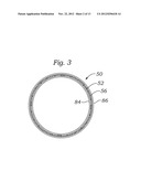 ENCAPSULATED HEART VALVE diagram and image