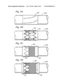 ENCAPSULATED HEART VALVE diagram and image