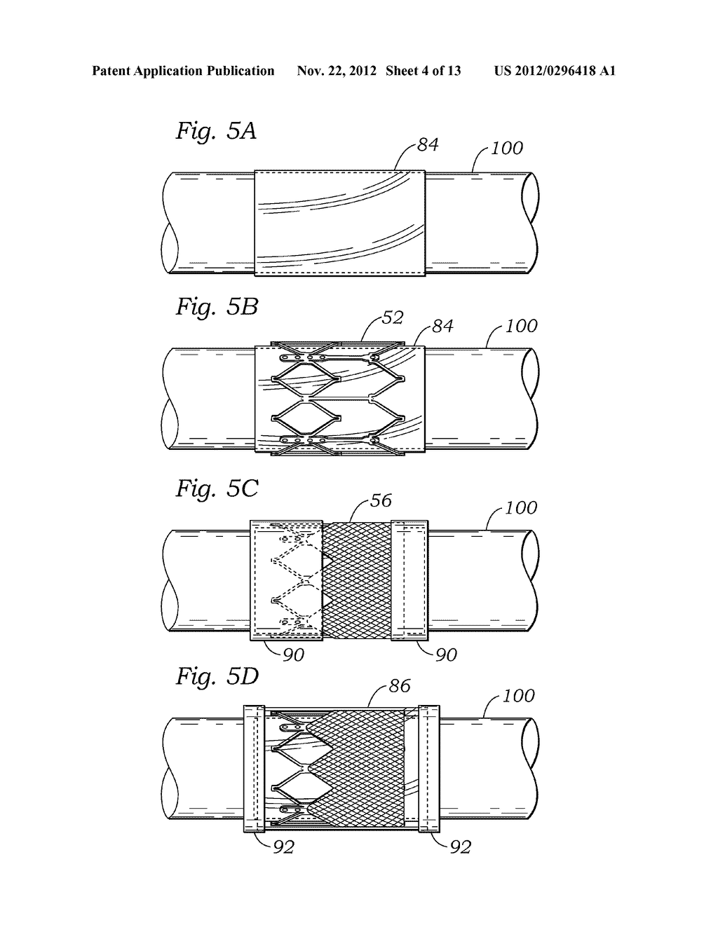 ENCAPSULATED HEART VALVE - diagram, schematic, and image 05