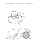 ENCAPSULATED HEART VALVE diagram and image