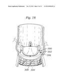 ENCAPSULATED HEART VALVE diagram and image