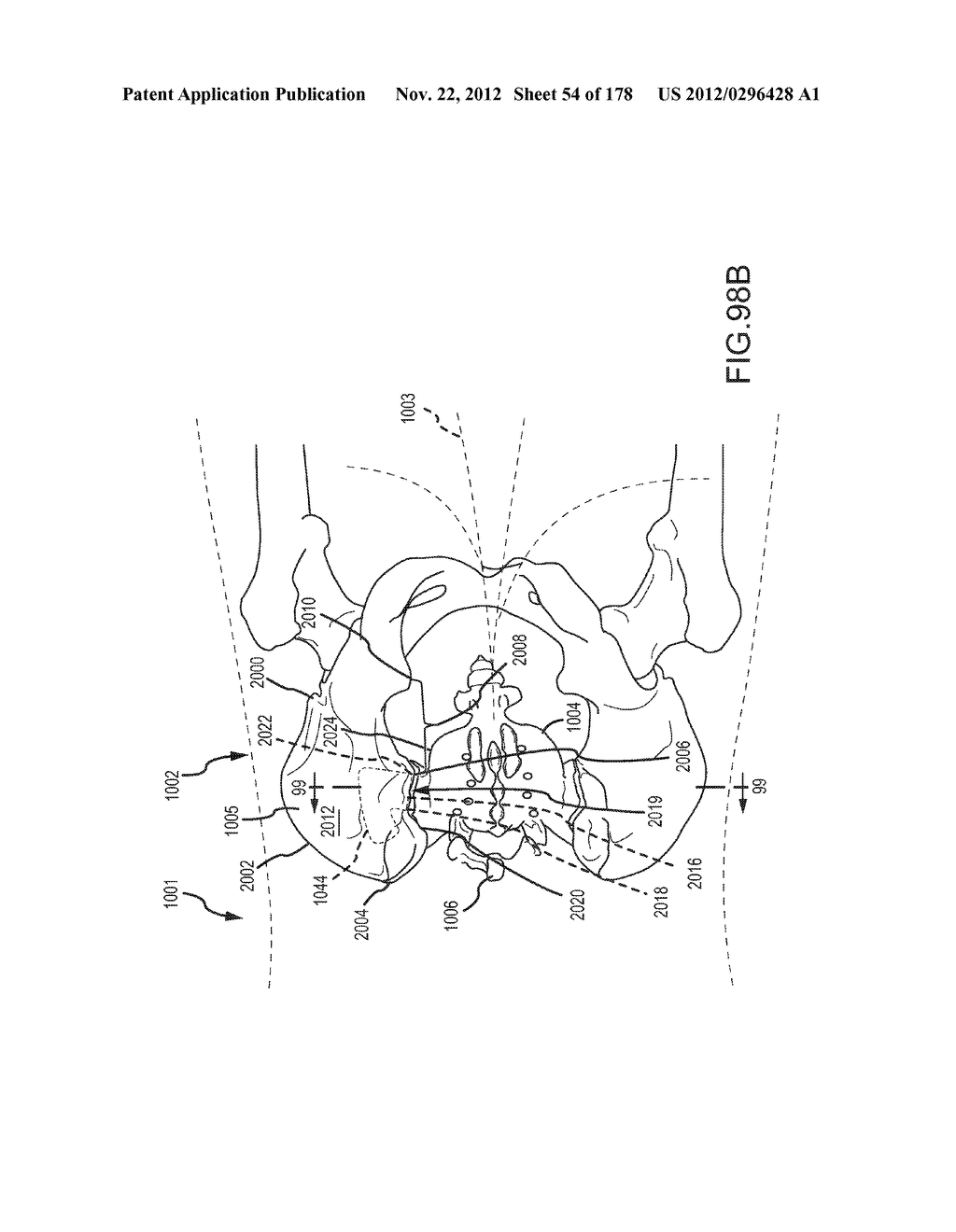 SYSTEMS FOR AND METHODS OF FUSING A SACROILIAC JOINT - diagram, schematic, and image 55