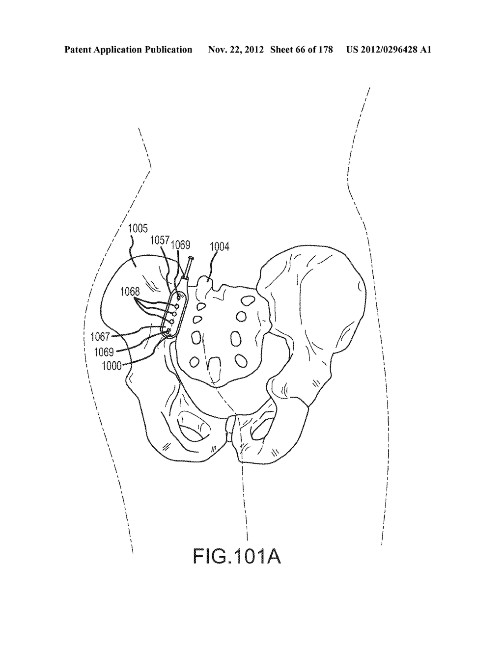 SYSTEMS FOR AND METHODS OF FUSING A SACROILIAC JOINT - diagram, schematic, and image 67