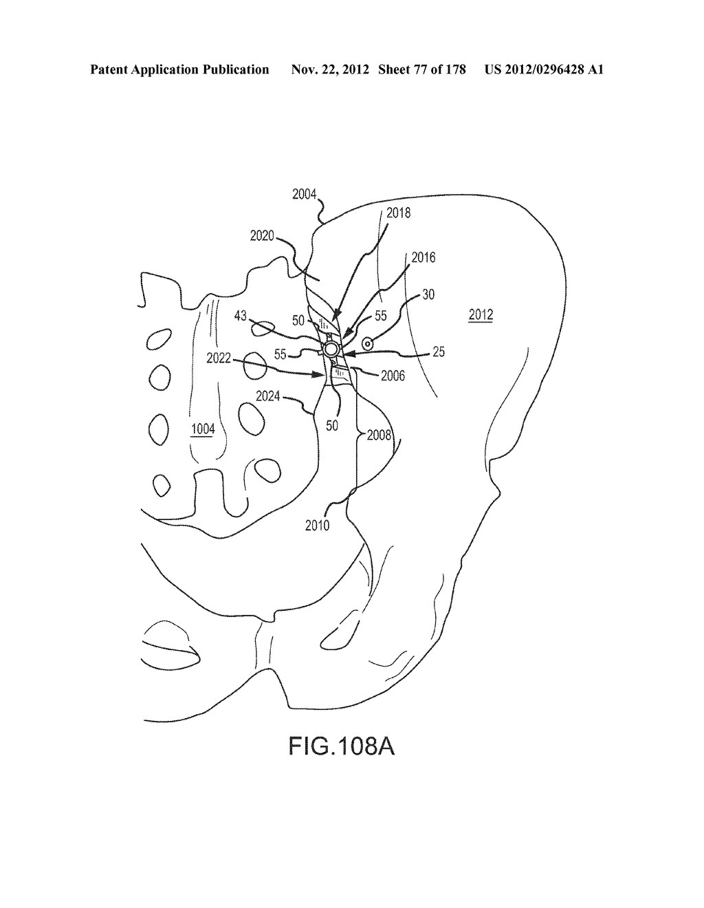 SYSTEMS FOR AND METHODS OF FUSING A SACROILIAC JOINT - diagram, schematic, and image 78