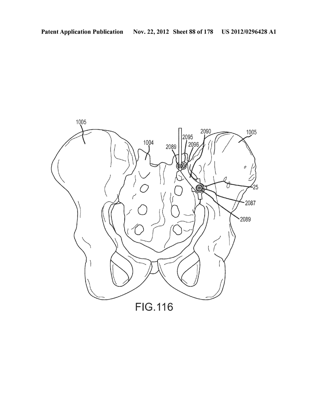 SYSTEMS FOR AND METHODS OF FUSING A SACROILIAC JOINT - diagram, schematic, and image 89