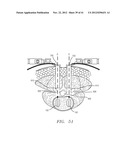 Prosthetic Intervertebral Disc Implants diagram and image