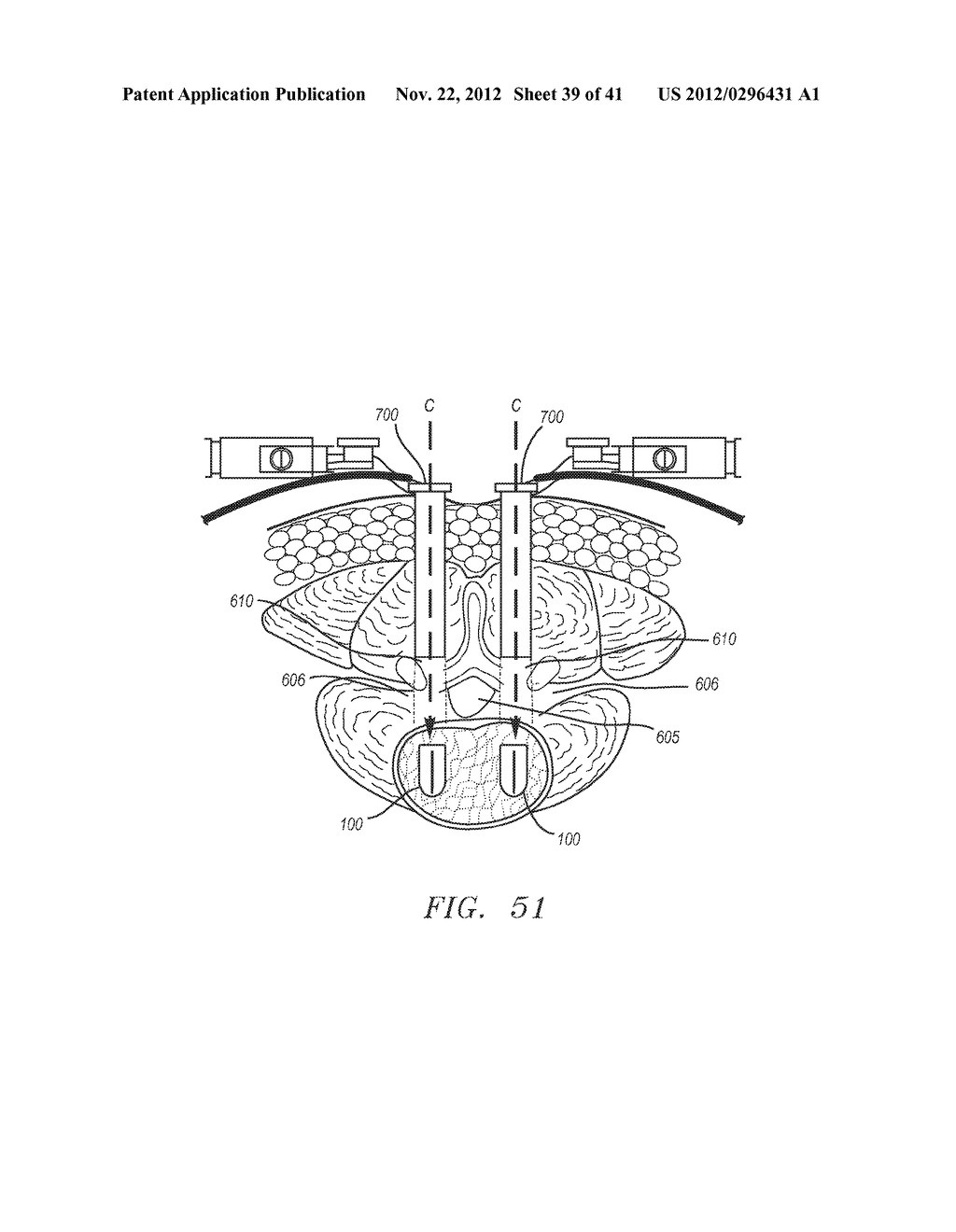 Prosthetic Intervertebral Disc Implants - diagram, schematic, and image 40