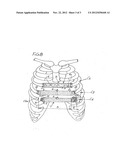 DEVICE FOR OSTEOSYNTHESIS OF THE THORACIC WALL diagram and image