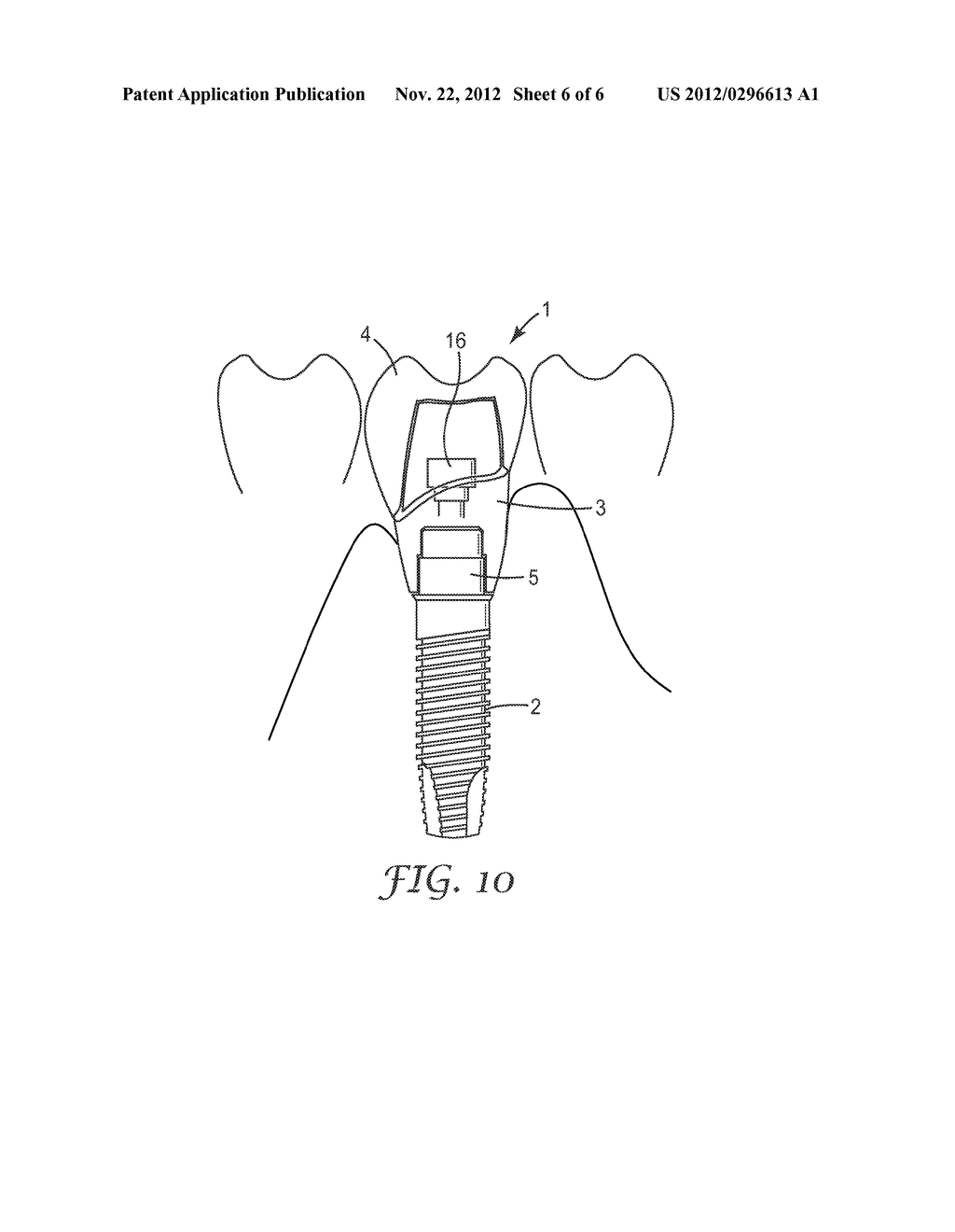 METHOD AND SYSTEM FOR DESIGNING A DENTAL RESTORATION - diagram, schematic, and image 07