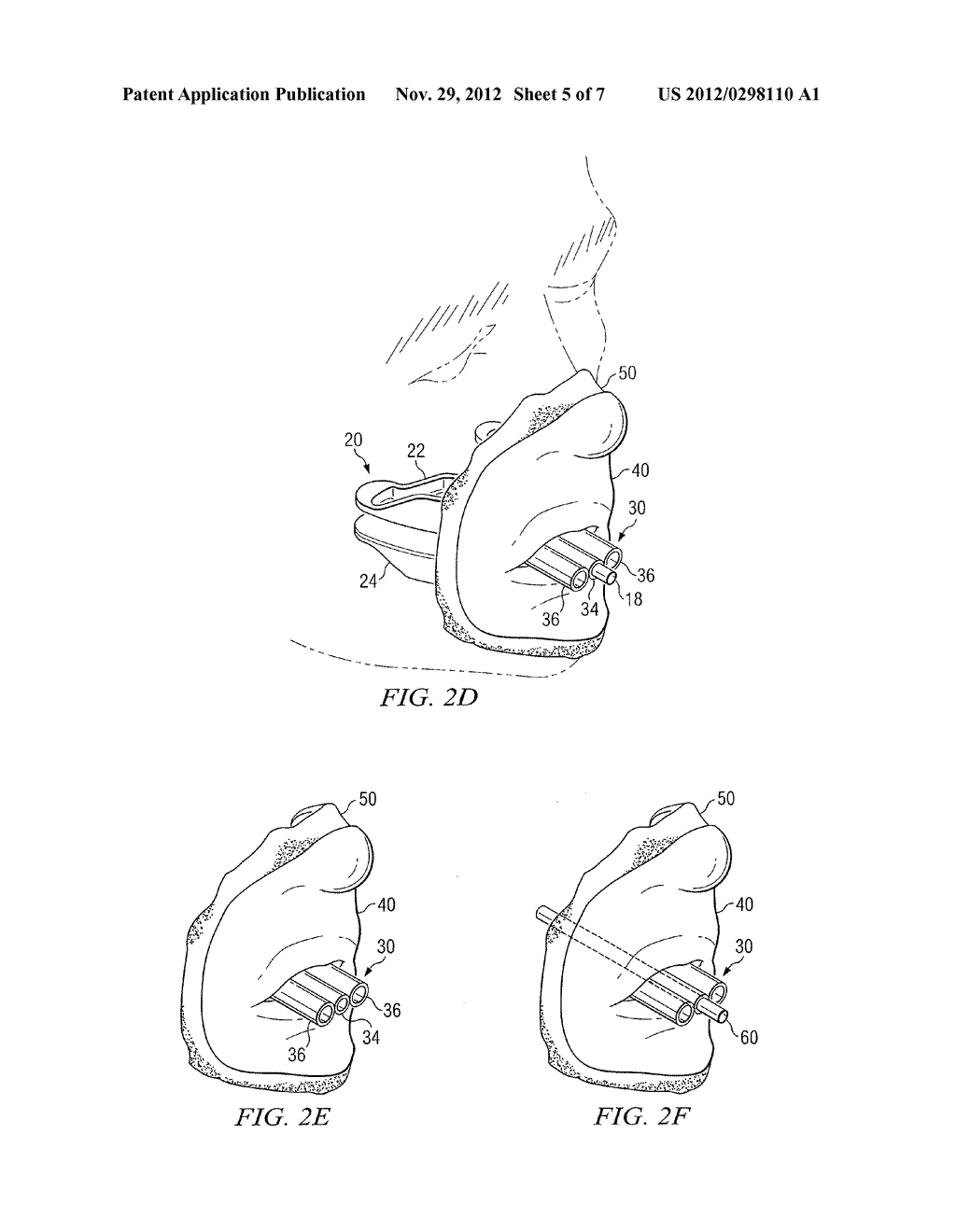 System and Method for Forming a Custom Medical Mask Using an Orientation     Device - diagram, schematic, and image 06