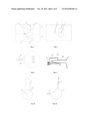 MANUFACTURING METHOD OF FOLDABLE ARTIFICIAL VITREOUS BODY AND MOULD     THEREOF diagram and image