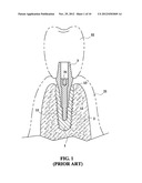 ZIRCONIUM OXIDE DENTAL IMPLANT WITH INTERNAL THREAD AND POLYGONAL TAPERING     SECTION, AND THE MOLD FOR MOLDING THE SAME diagram and image