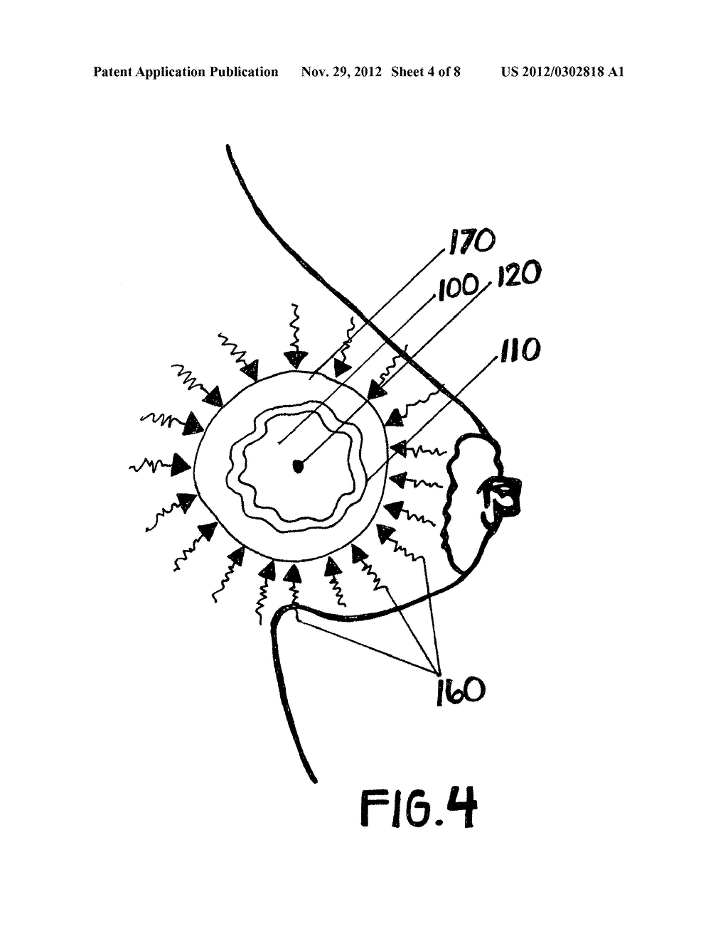 METHOD OF UTILIZING AN IMPLANT FOR TARGETING EXTERNAL BEAM RADIATION - diagram, schematic, and image 05