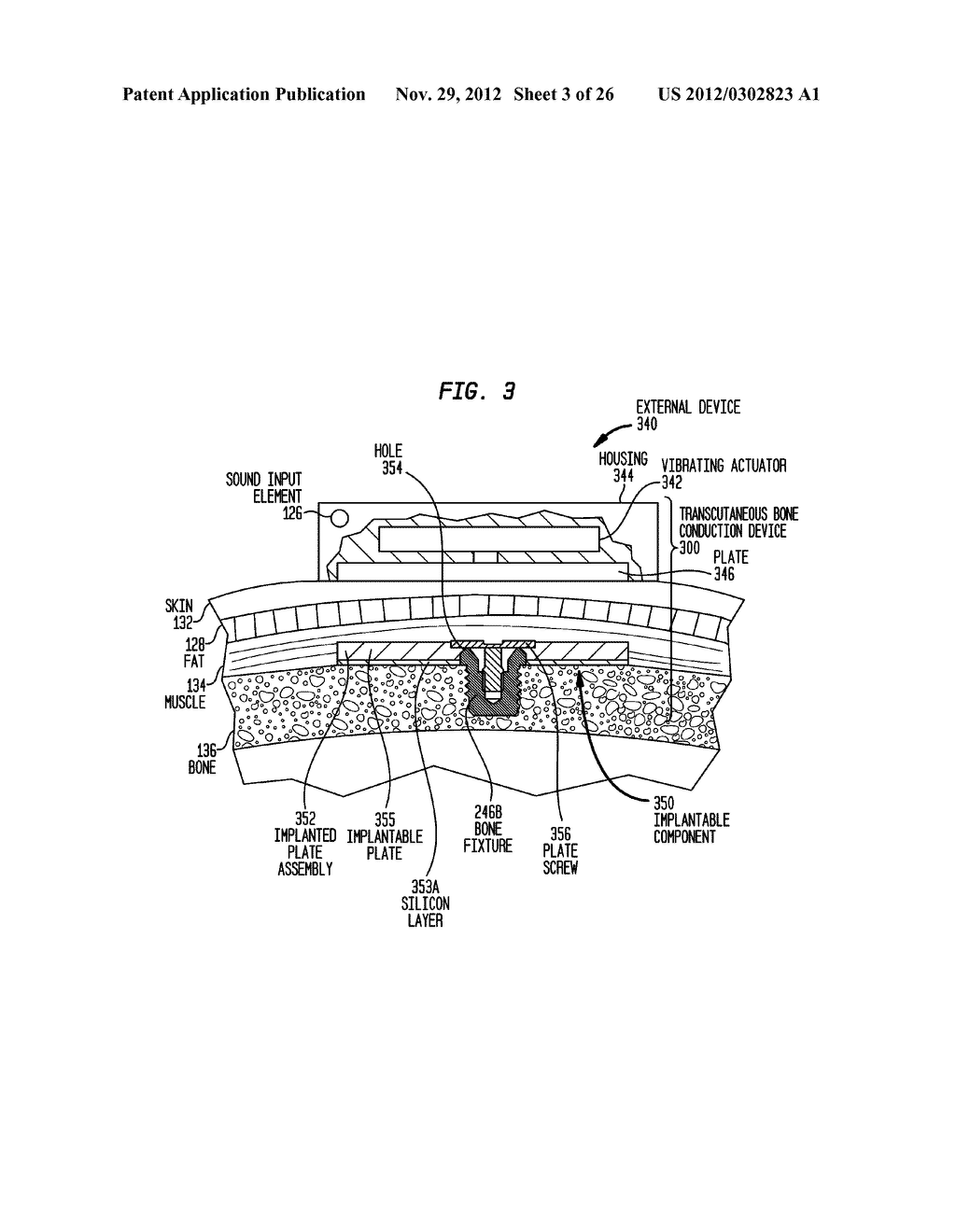 CONVERTIBILITY OF A  BONE CONDUCTION DEVICE - diagram, schematic, and image 04